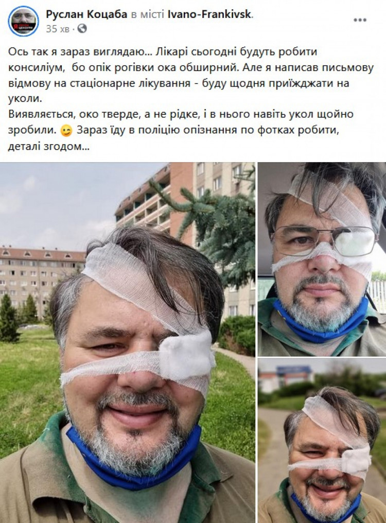 У Коцаби діагностували опік рогівки ока